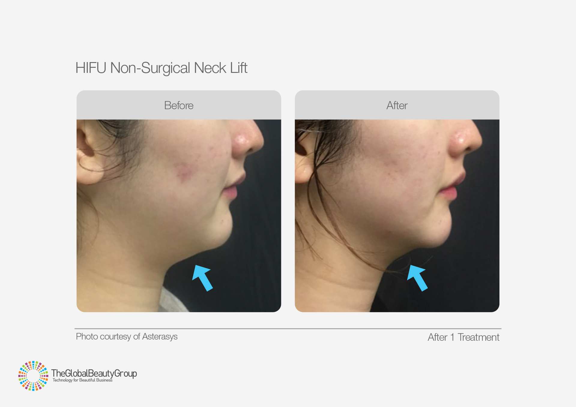 HIFU Before & After 1