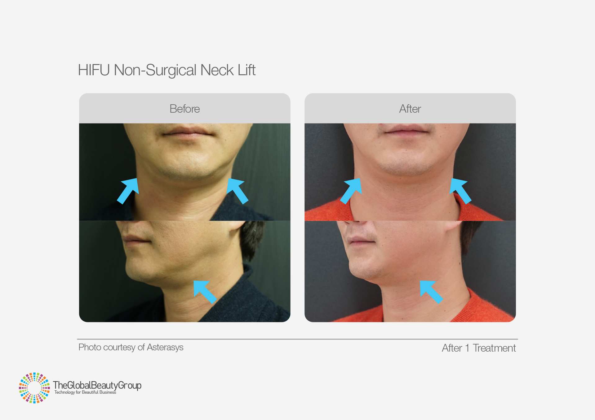 HIFU Before & After 3