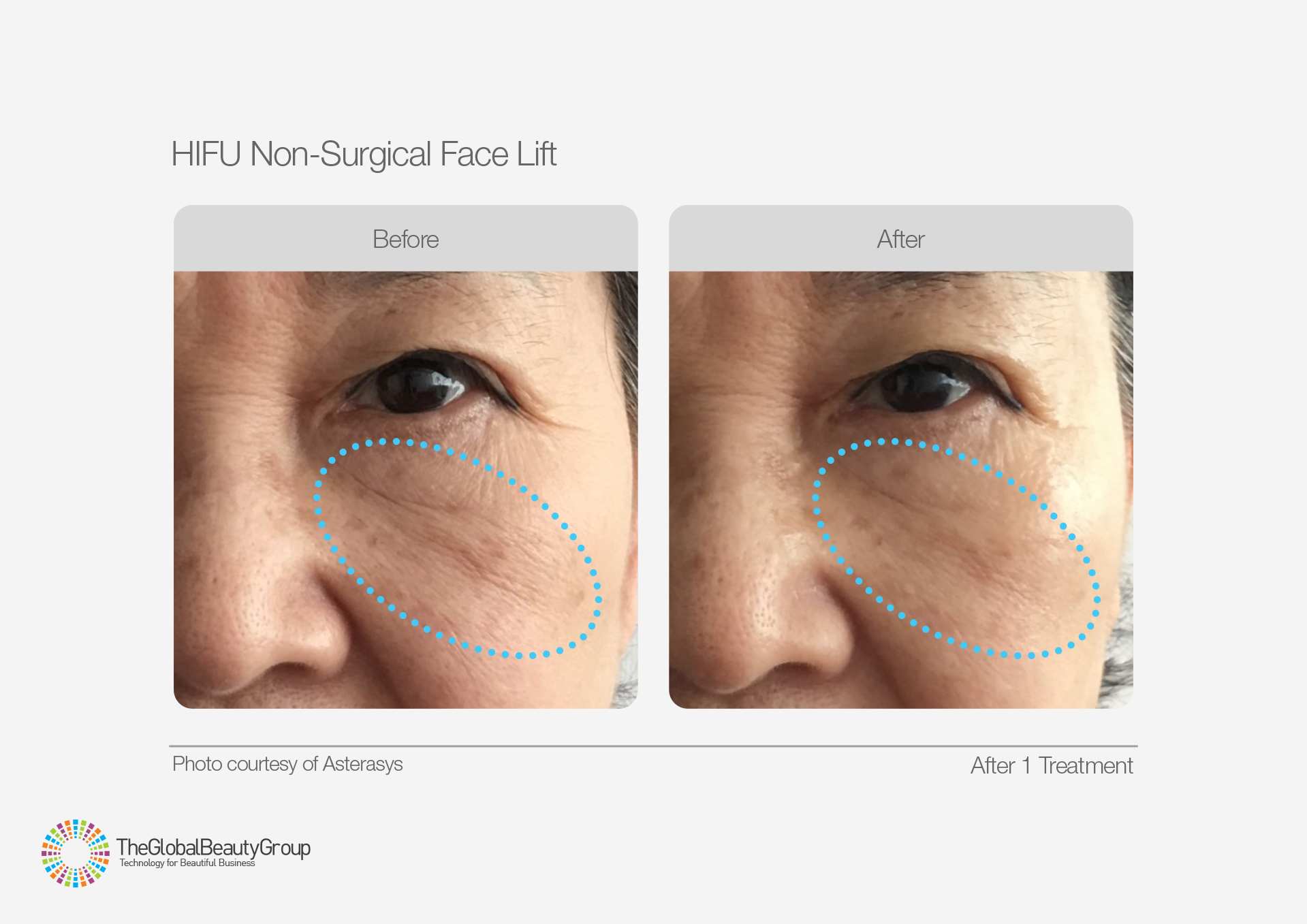 HIFU Before & After 5