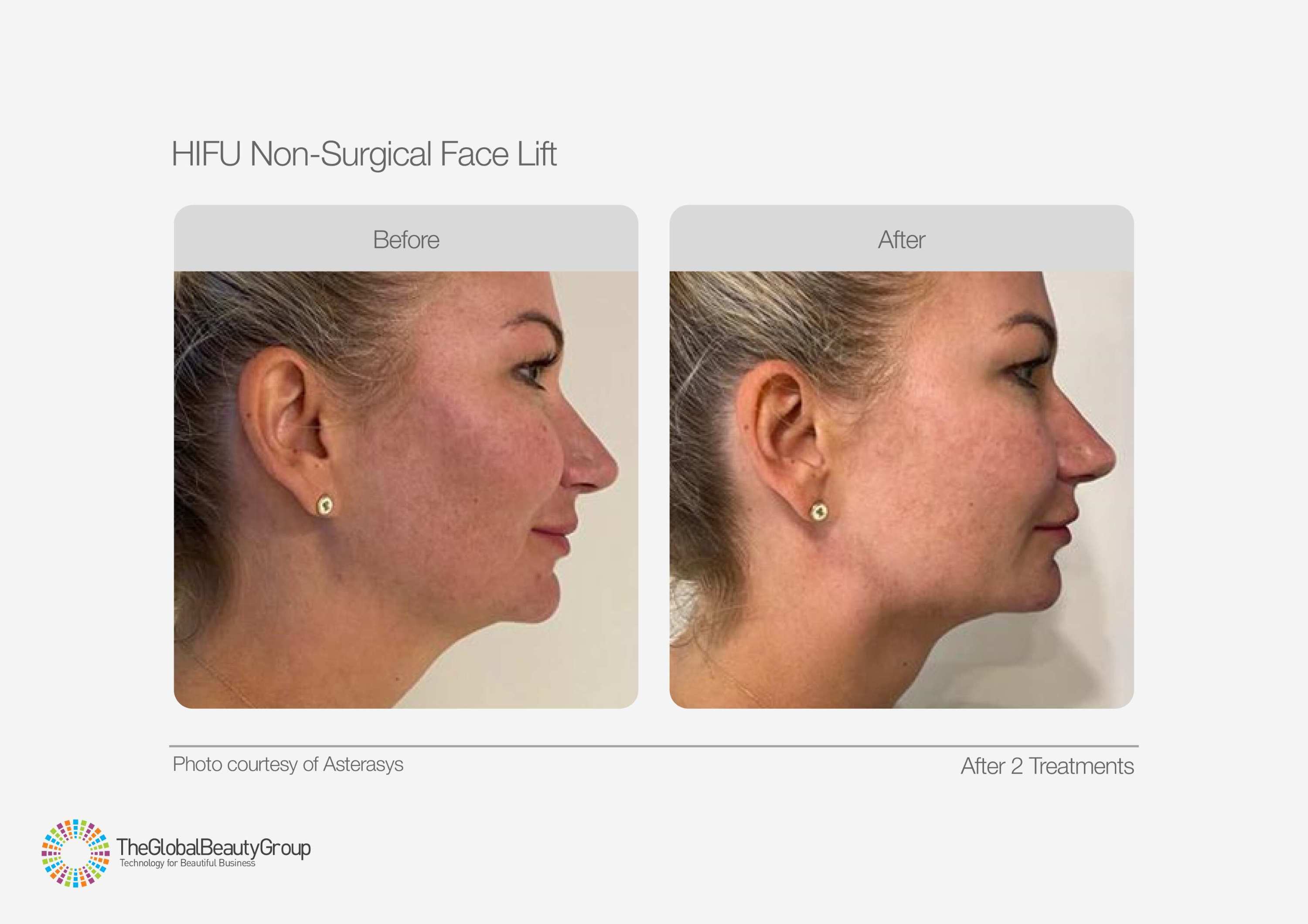 HIFU Before & After 6