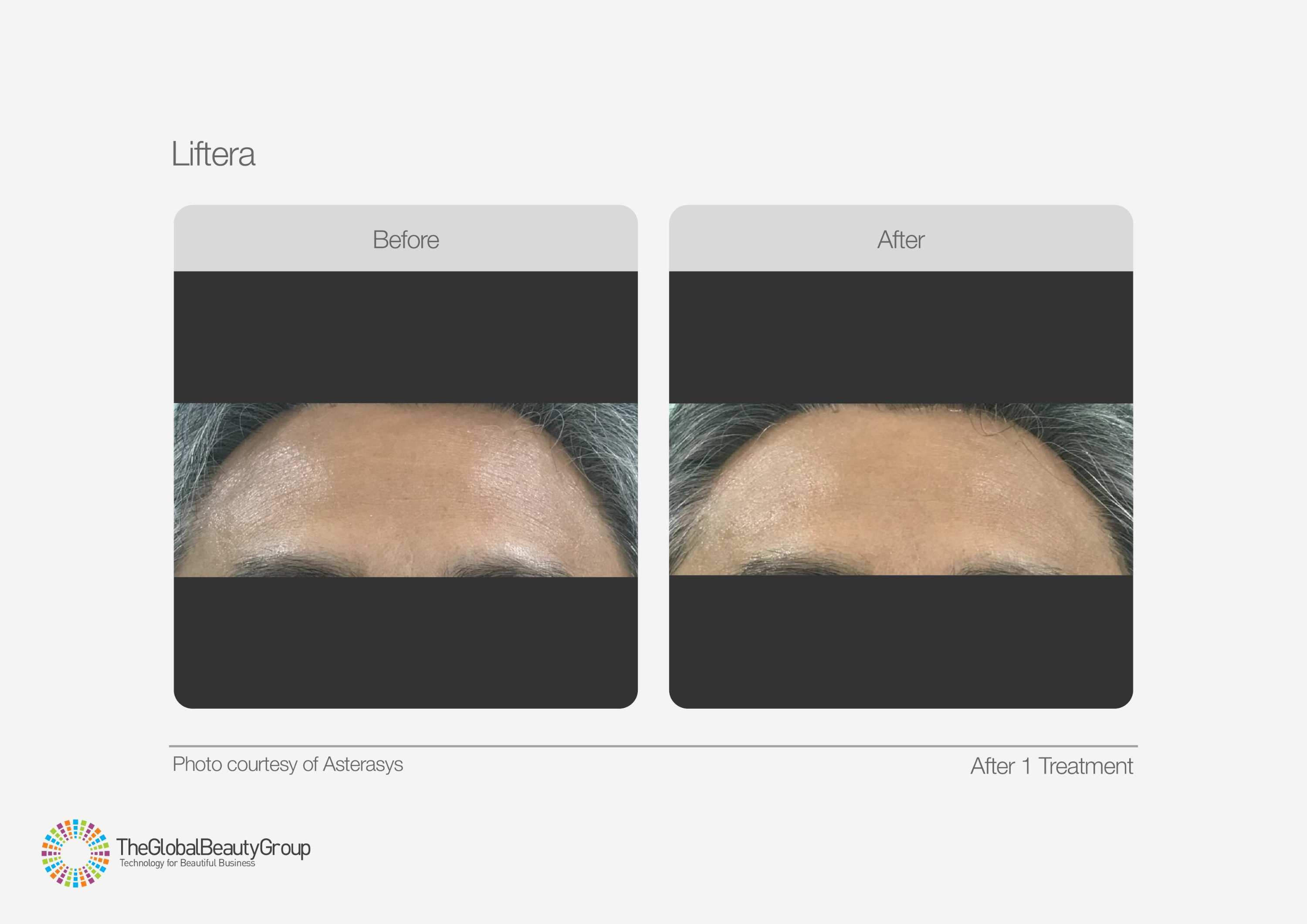 HIFU Before & After 7