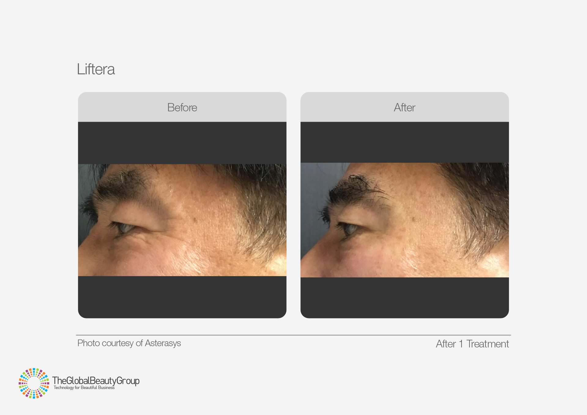 HIFU Before & After 8