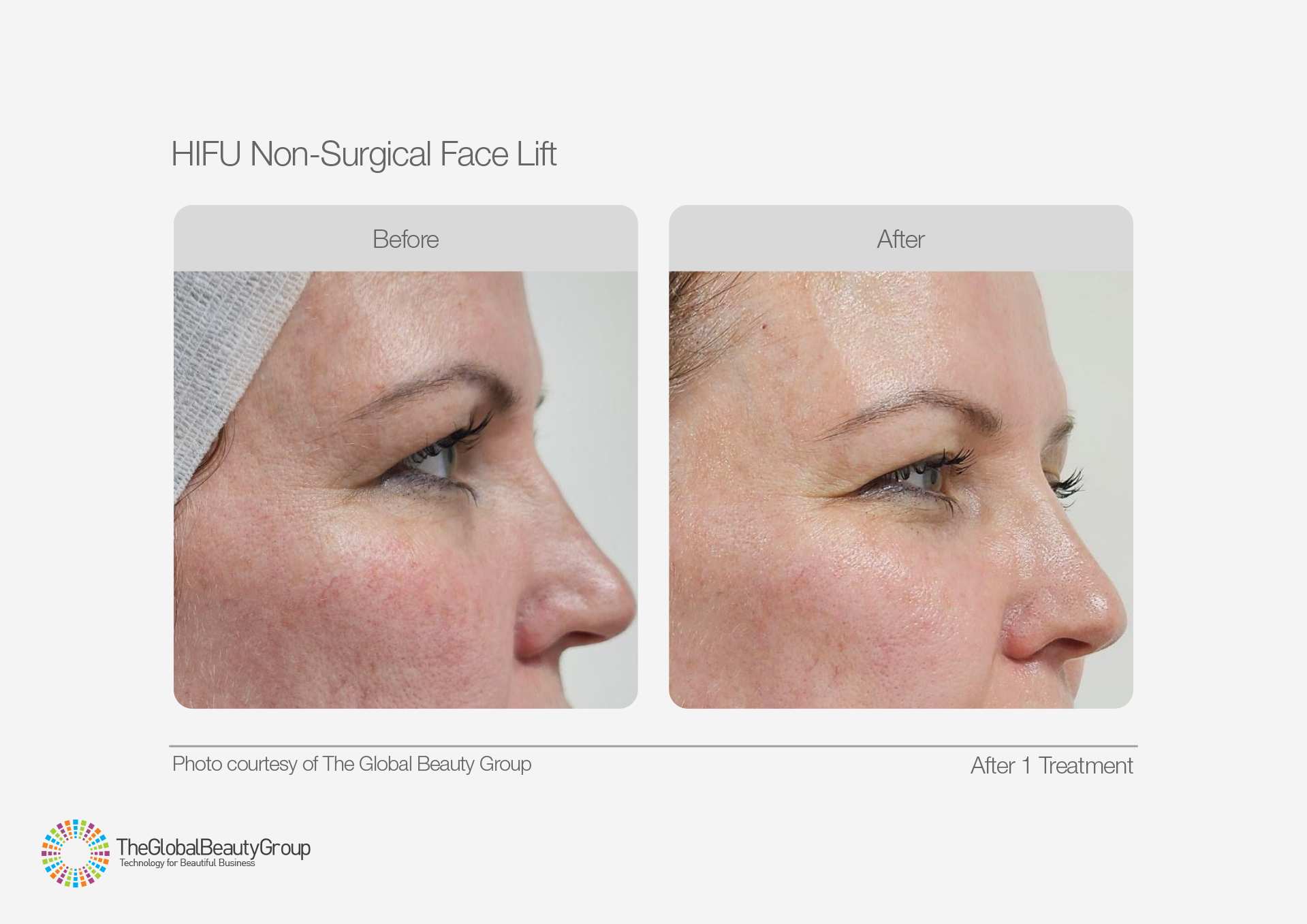 HIFU Before & After 9