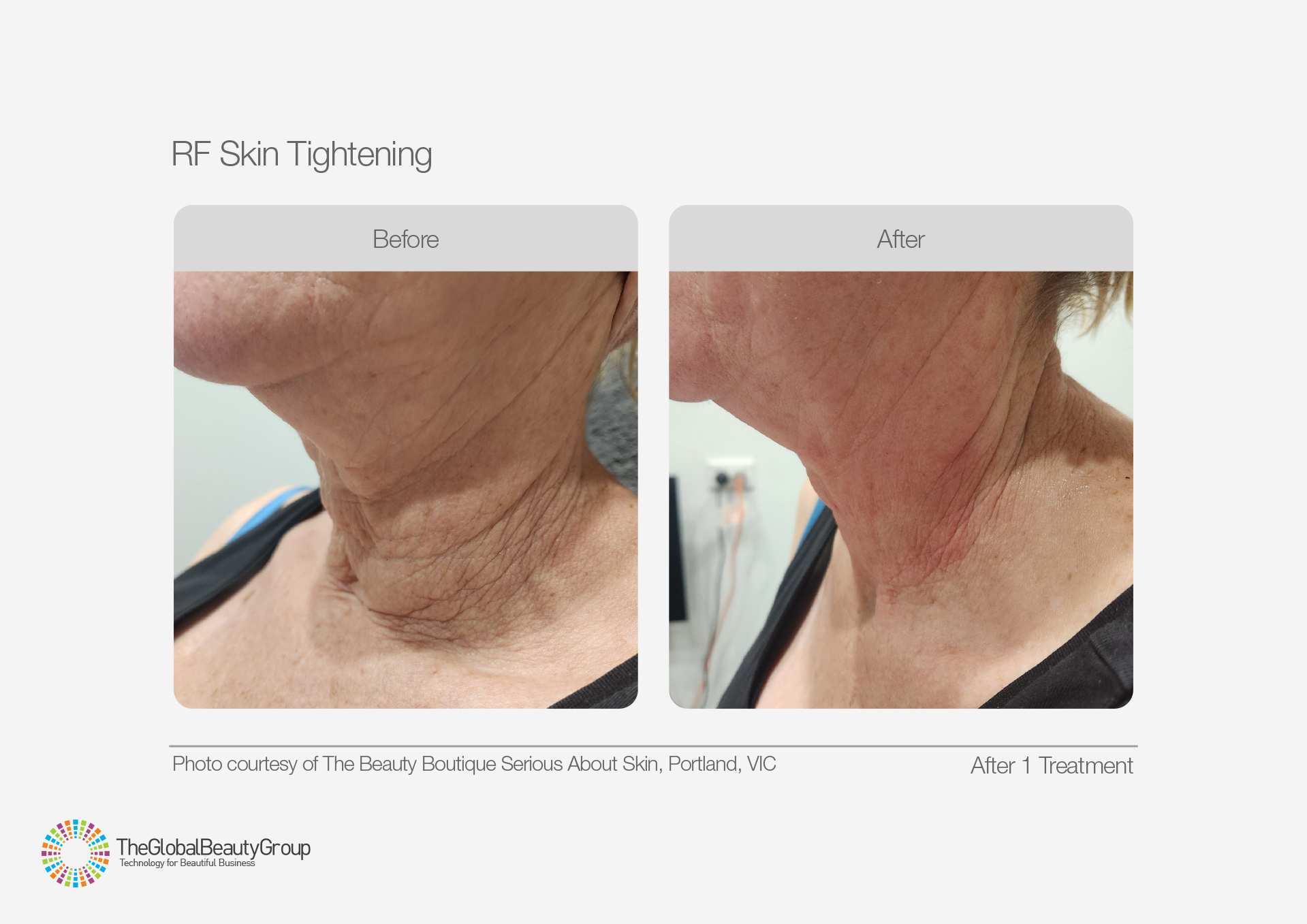 RF Skin Tightening Before and After Results 6