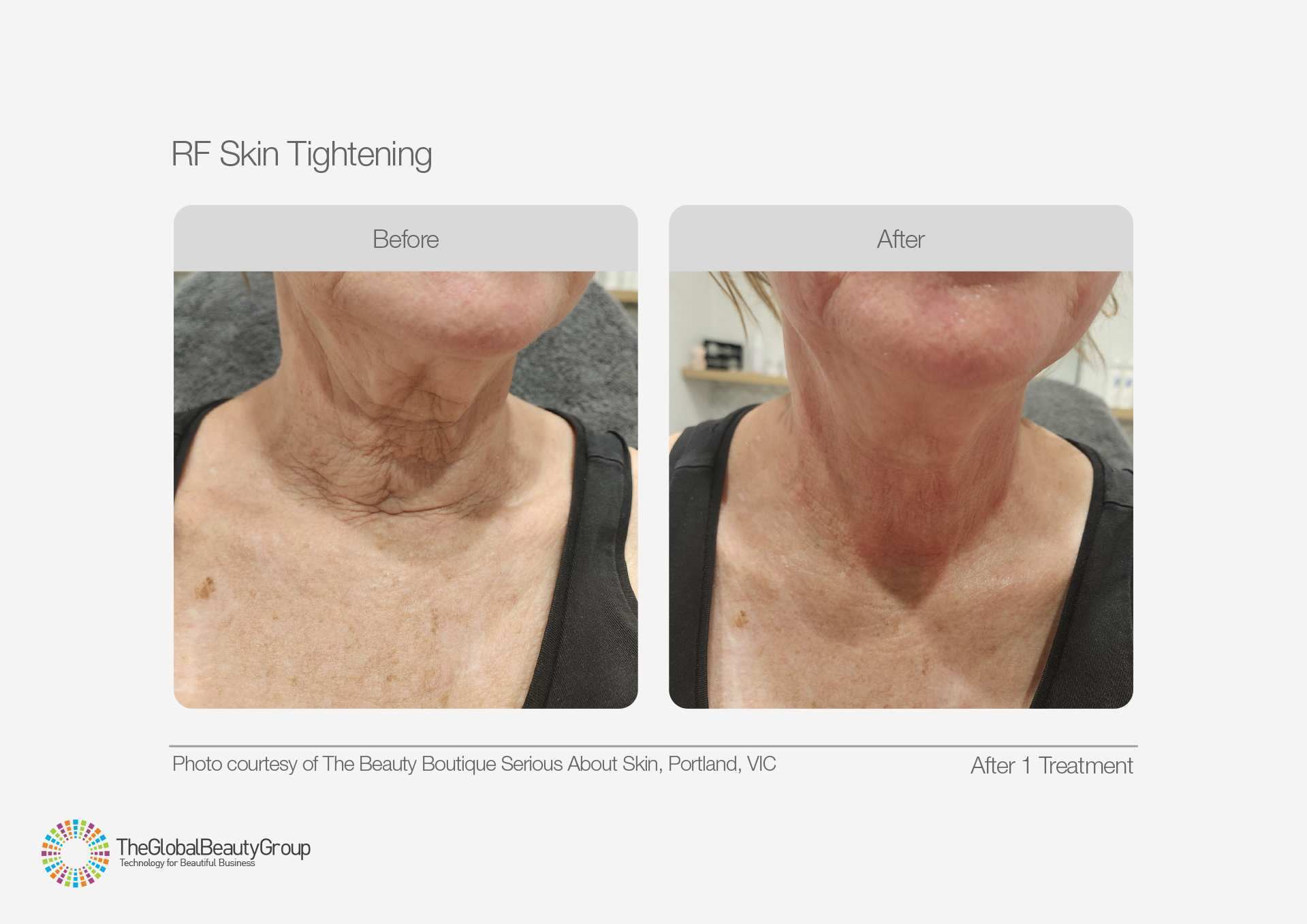 RF Skin Tightening Before and After Results 5