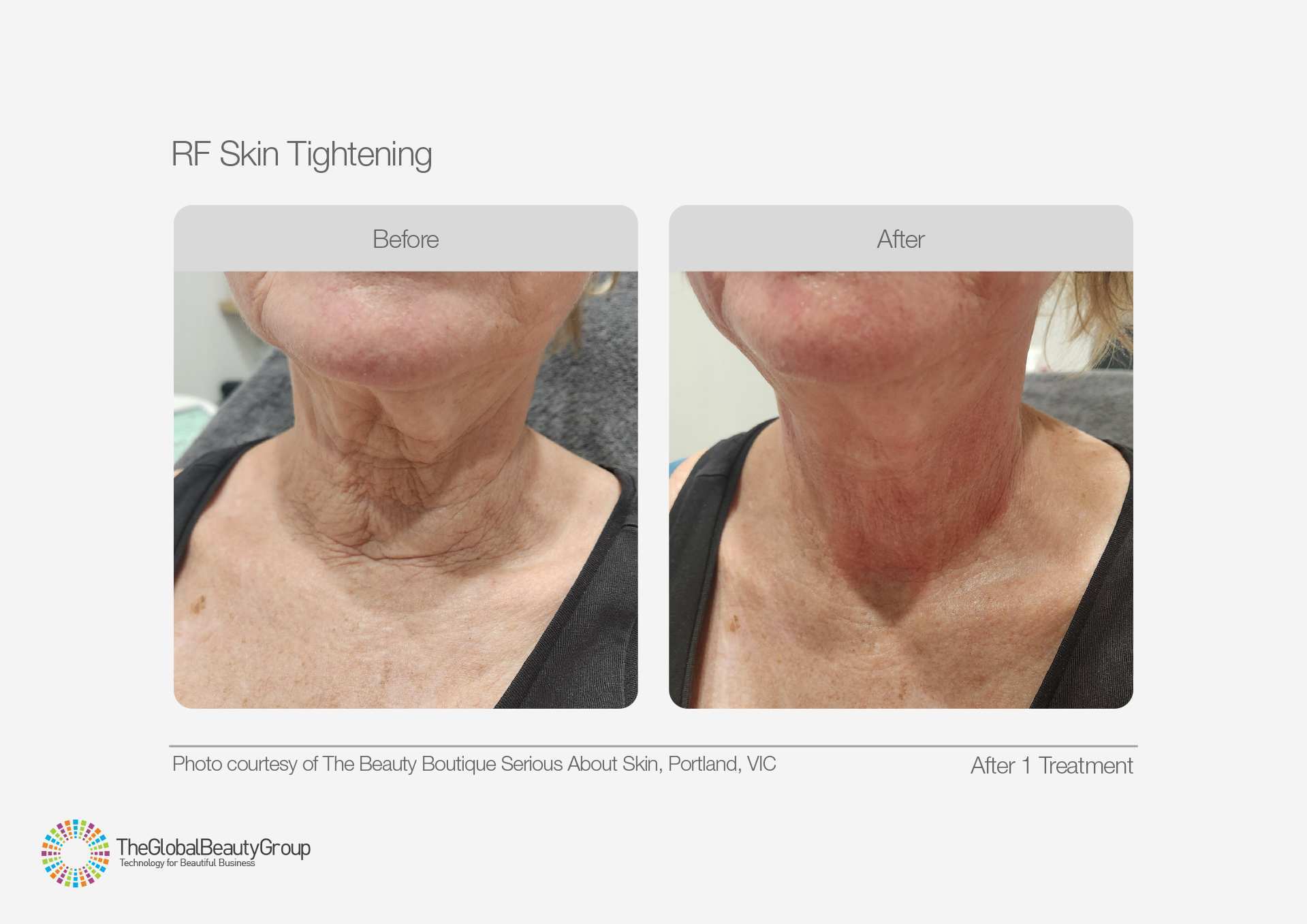 RF Skin Tightening Before and After Results 4