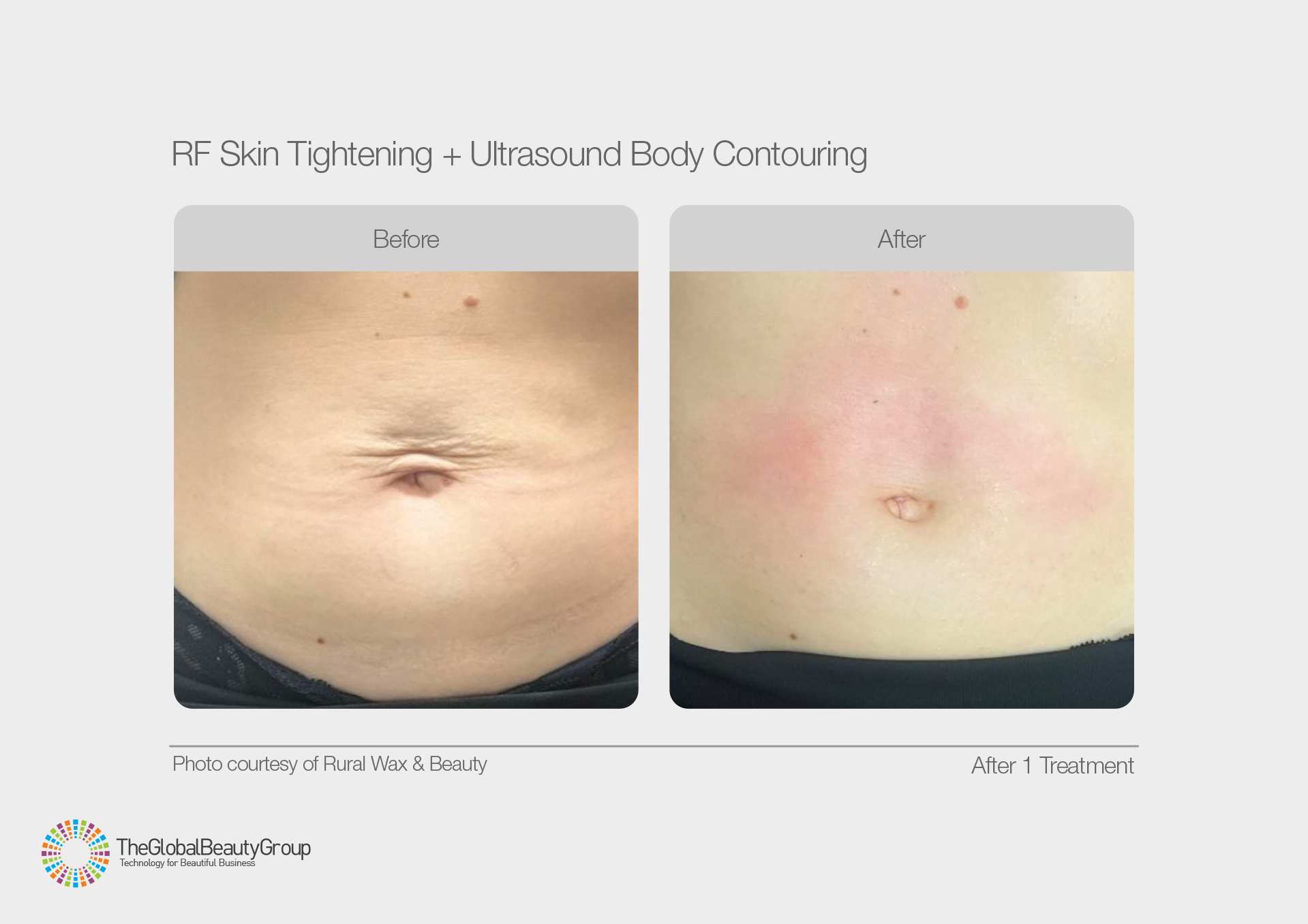 RF Skin Tightening and Ultrasound Body Contouring Results