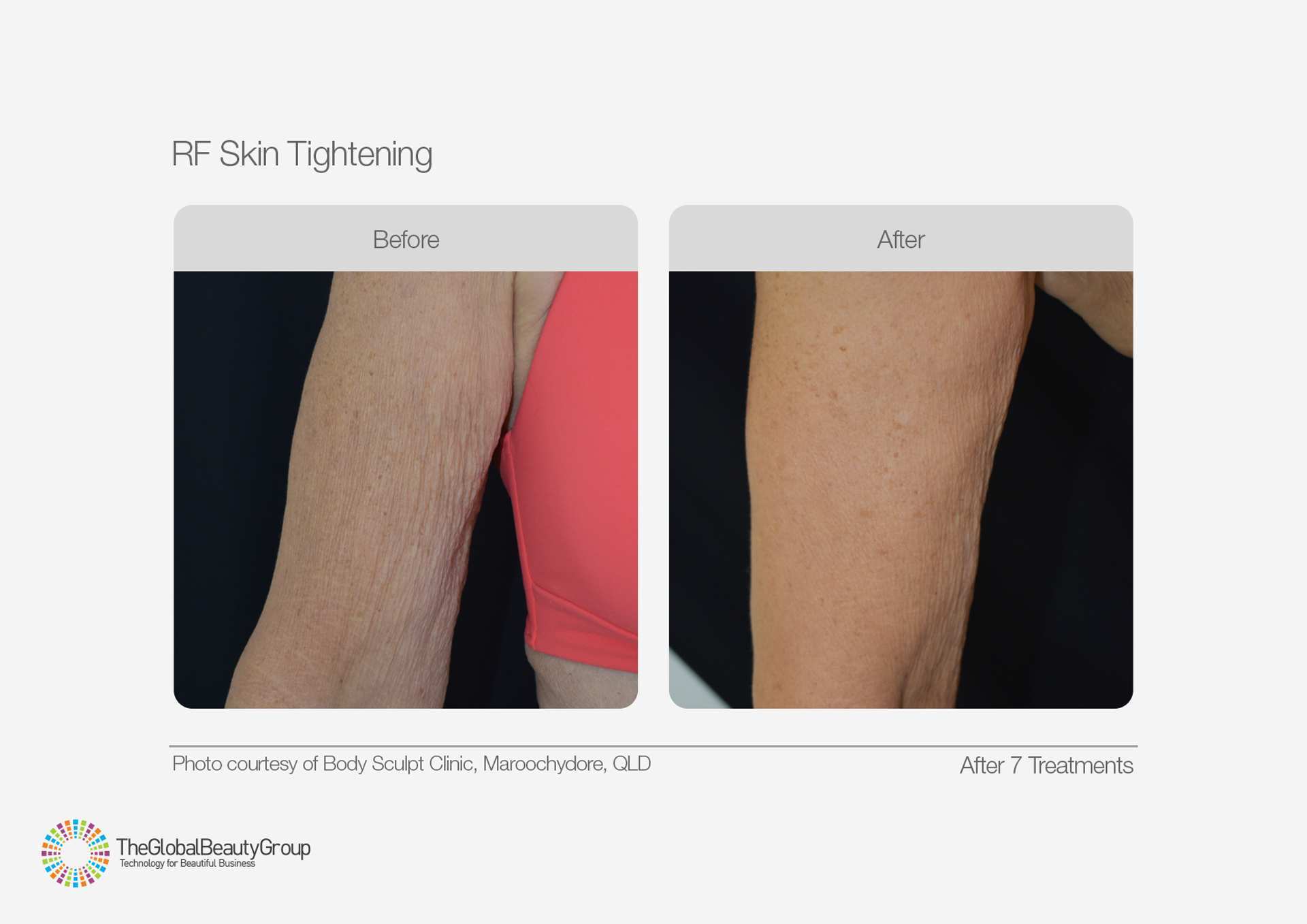 RF Skin Tightening Before and After Results 2