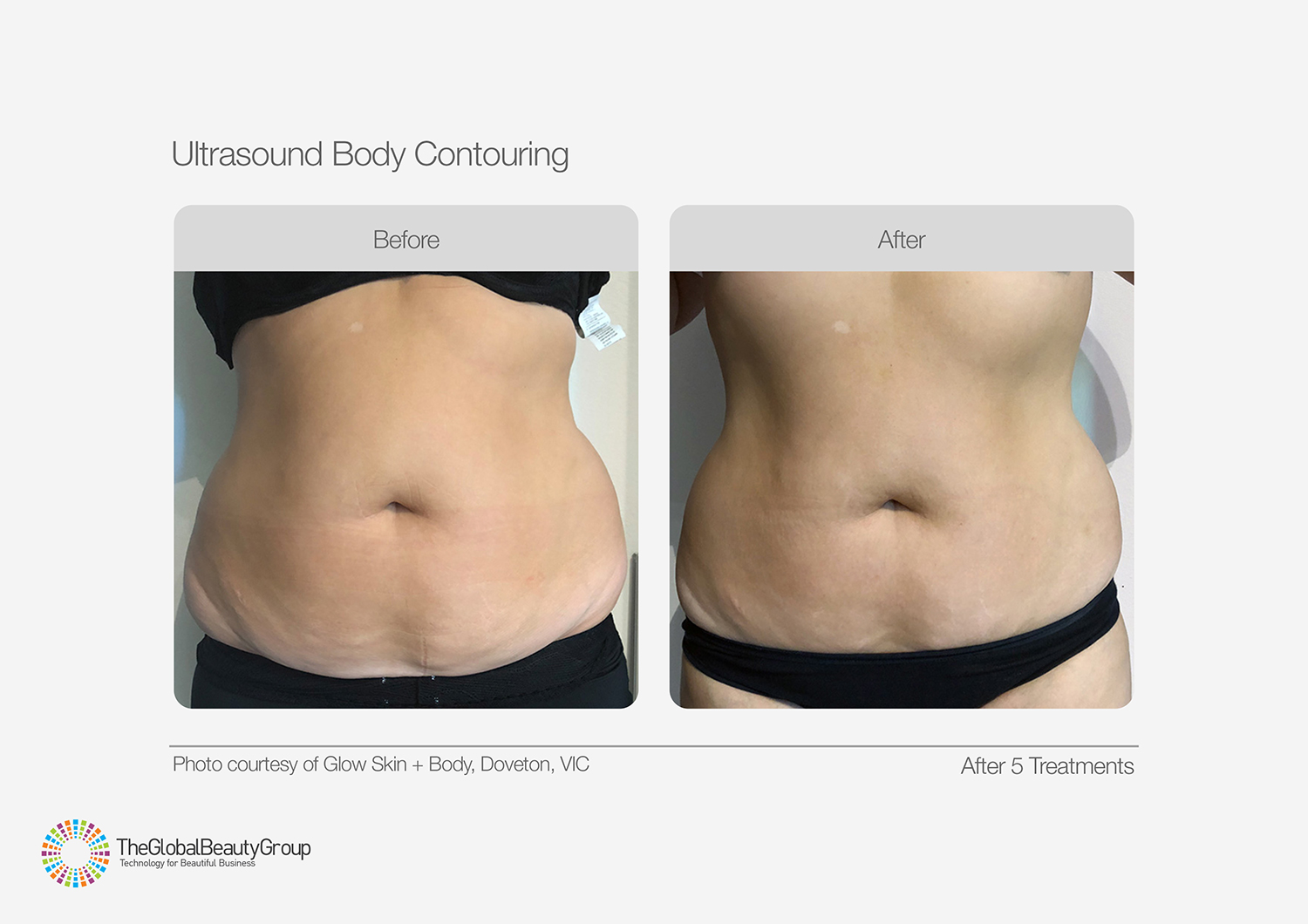 Ultrasound Body Contouring Before & After 5