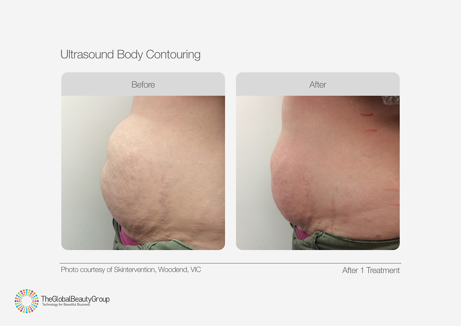 Ultrasound Body Contouring Before & After 7