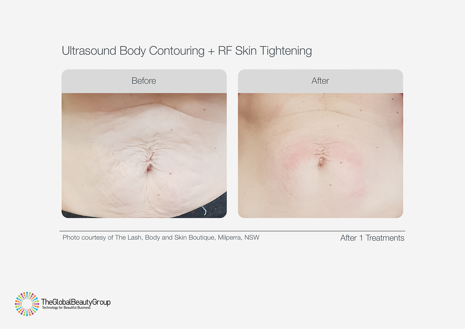 Ultrasound Body Contouring Before & After 9