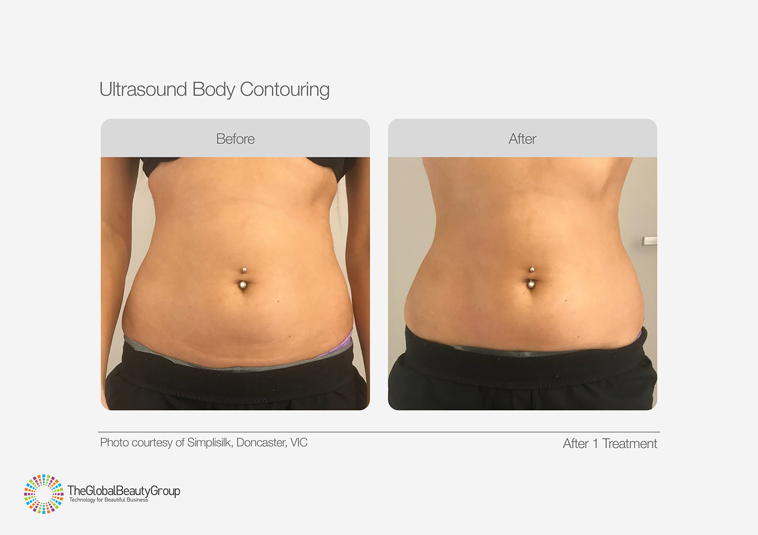 Ultrasound Body Contouring Before & After 10