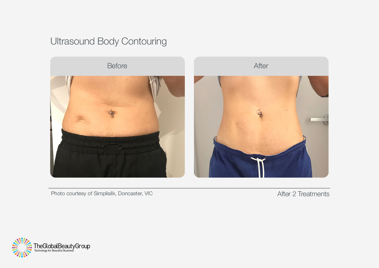 Ultrasound Body Contouring Before & After 11