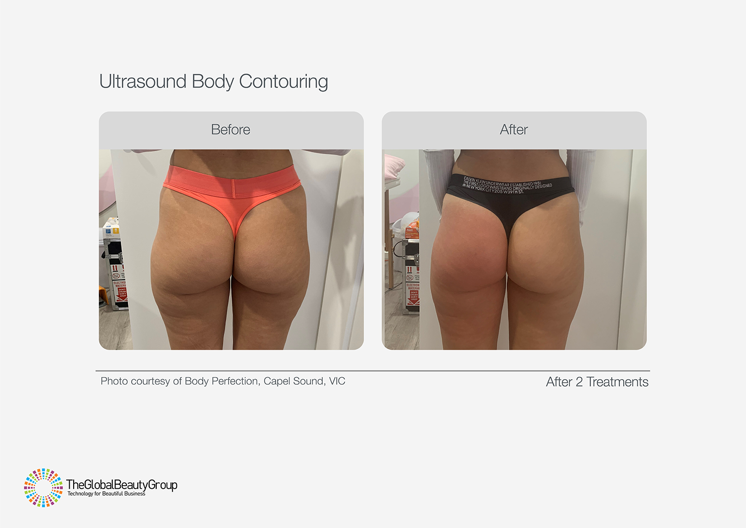Ultrasound Body Contouring Before & After 12