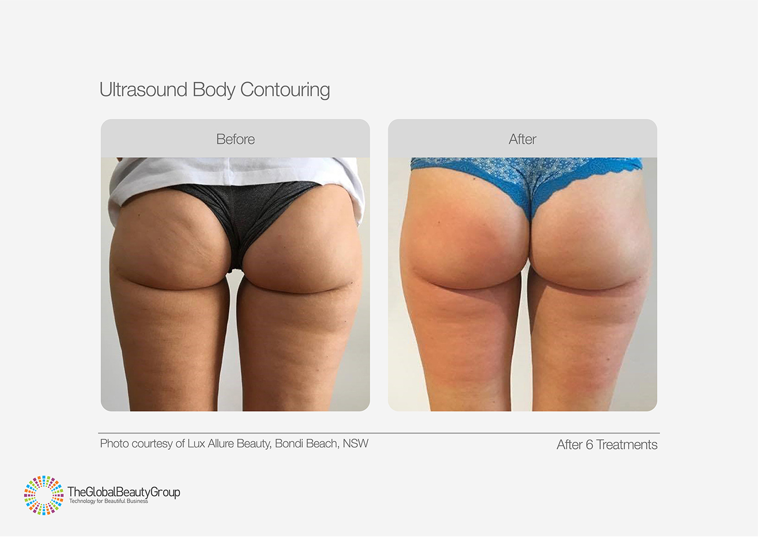 Ultrasound Body Contouring Before & After 13