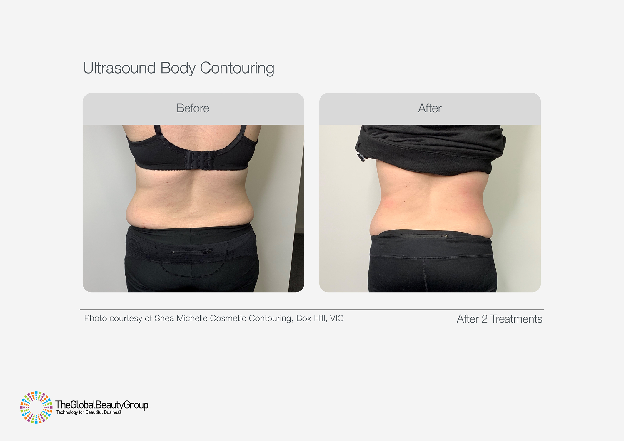 Ultrasound Body Contouring Before & After 14