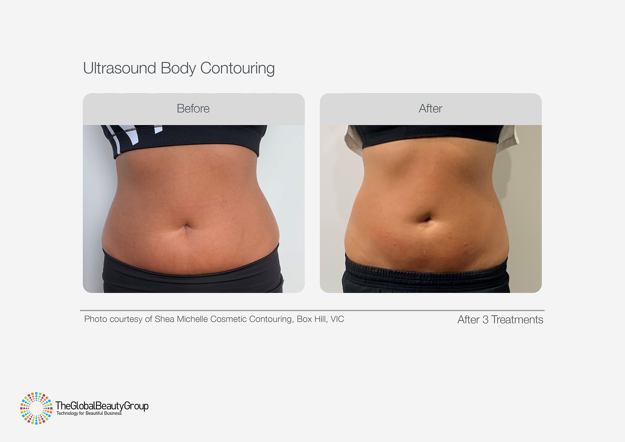 Ultrasound Body Contouring Before & After 16