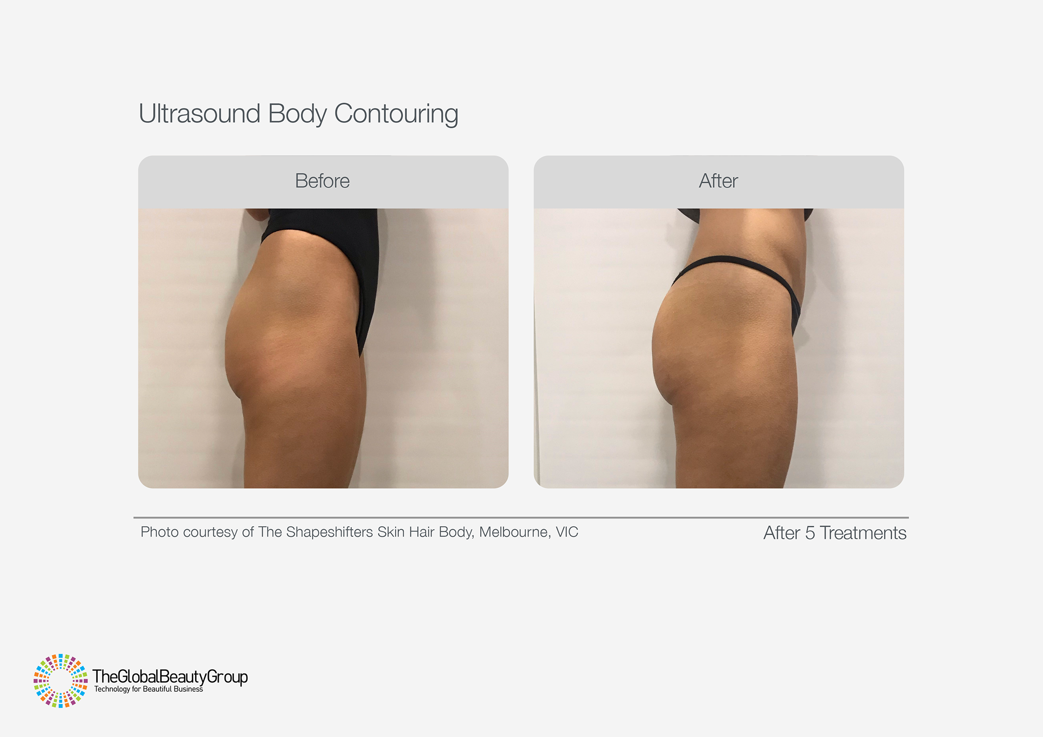 Ultrasound Body Contouring Before & After 17