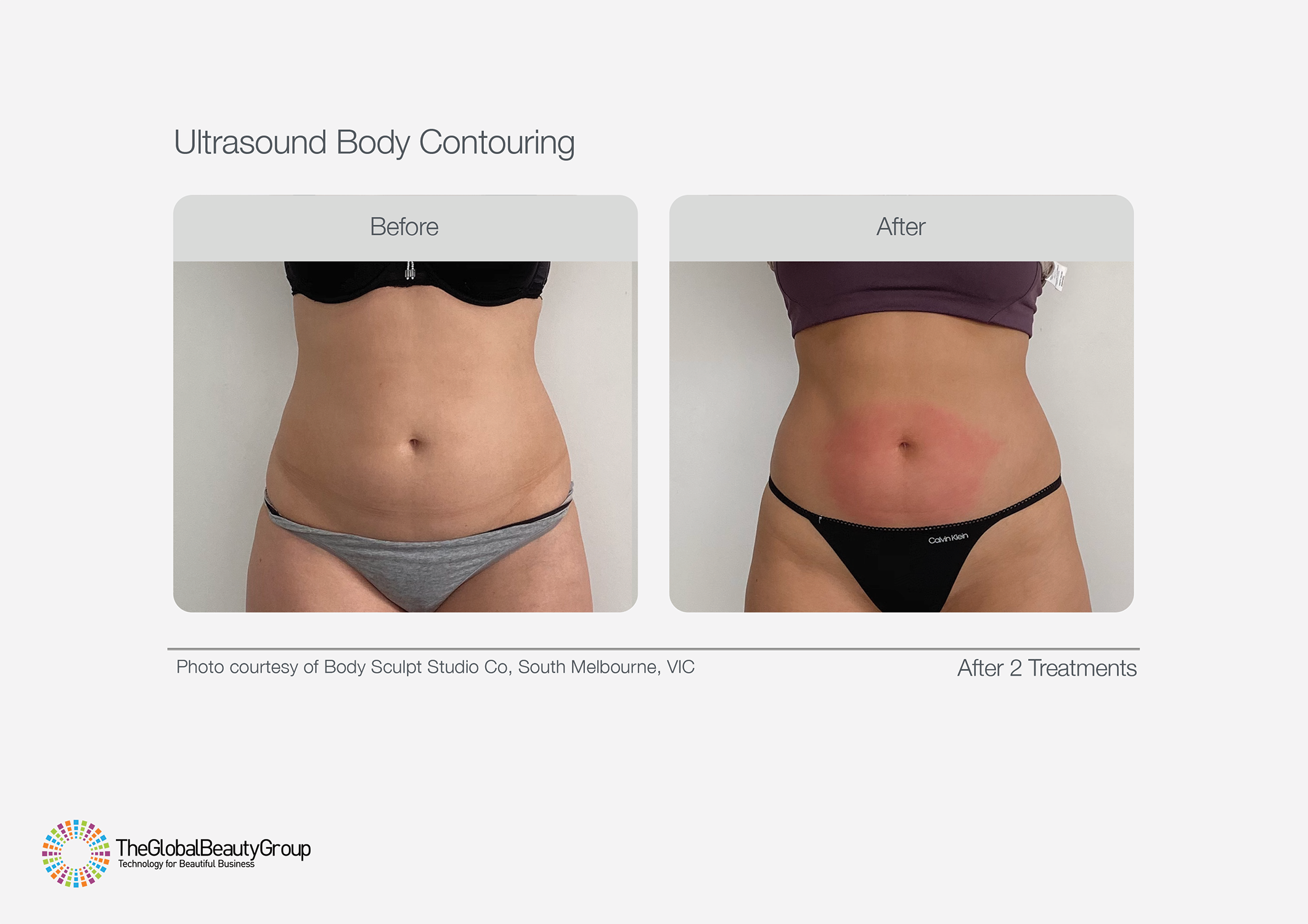 Ultrasound Body Contouring Before & After 18